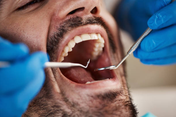 Best Emergency Tooth Extraction in Valenti, NE